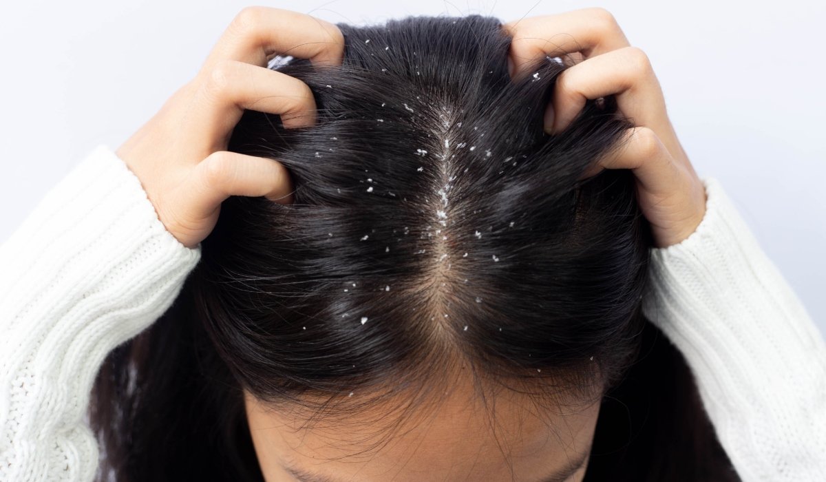 Remedii naturale pentru combaterea mătreții. Soluții simple pentru un scalp sănătos 1 wp header logo 2429