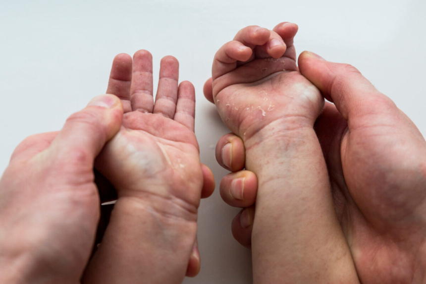 Dermatita atopică la copii – ghid complet pentru părinți 1 wp header logo 221