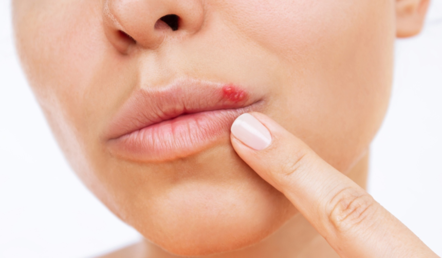 Simți că îți apare herpes? Ce să faci imediat ca să nu erupă 1 wp header logo 156