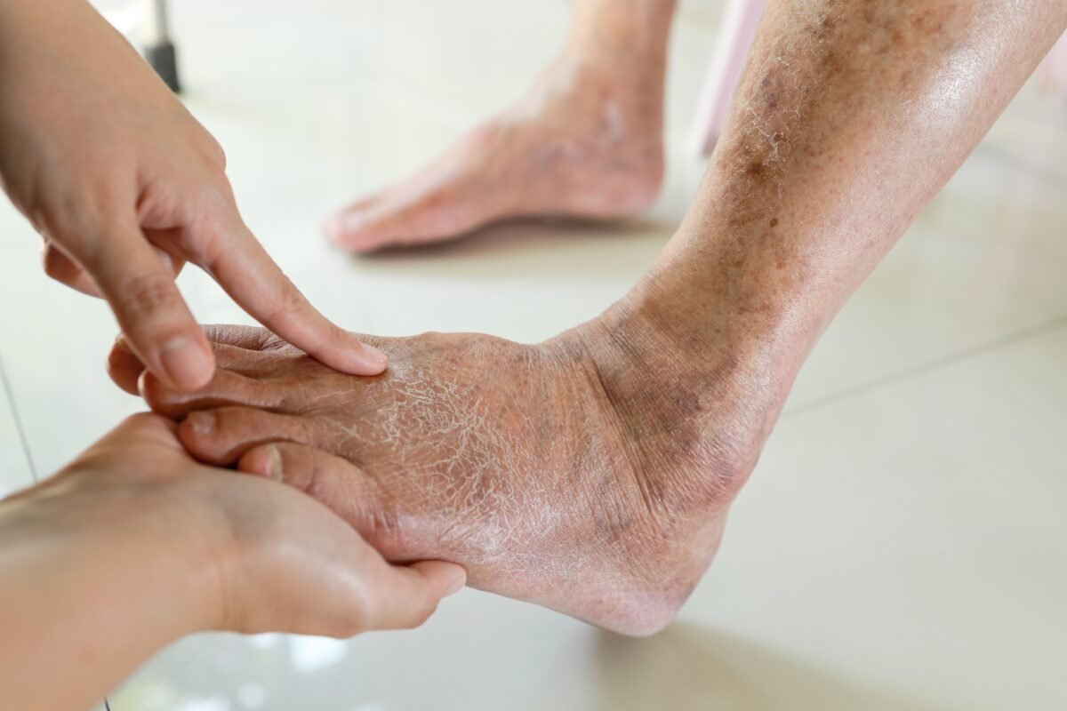 Picioare umflate, urină spumoasă și oboseală persistentă? Semne care pot indica probleme renale la persoanele cu diabet sau hipertensiune 1 wp header logo 1564