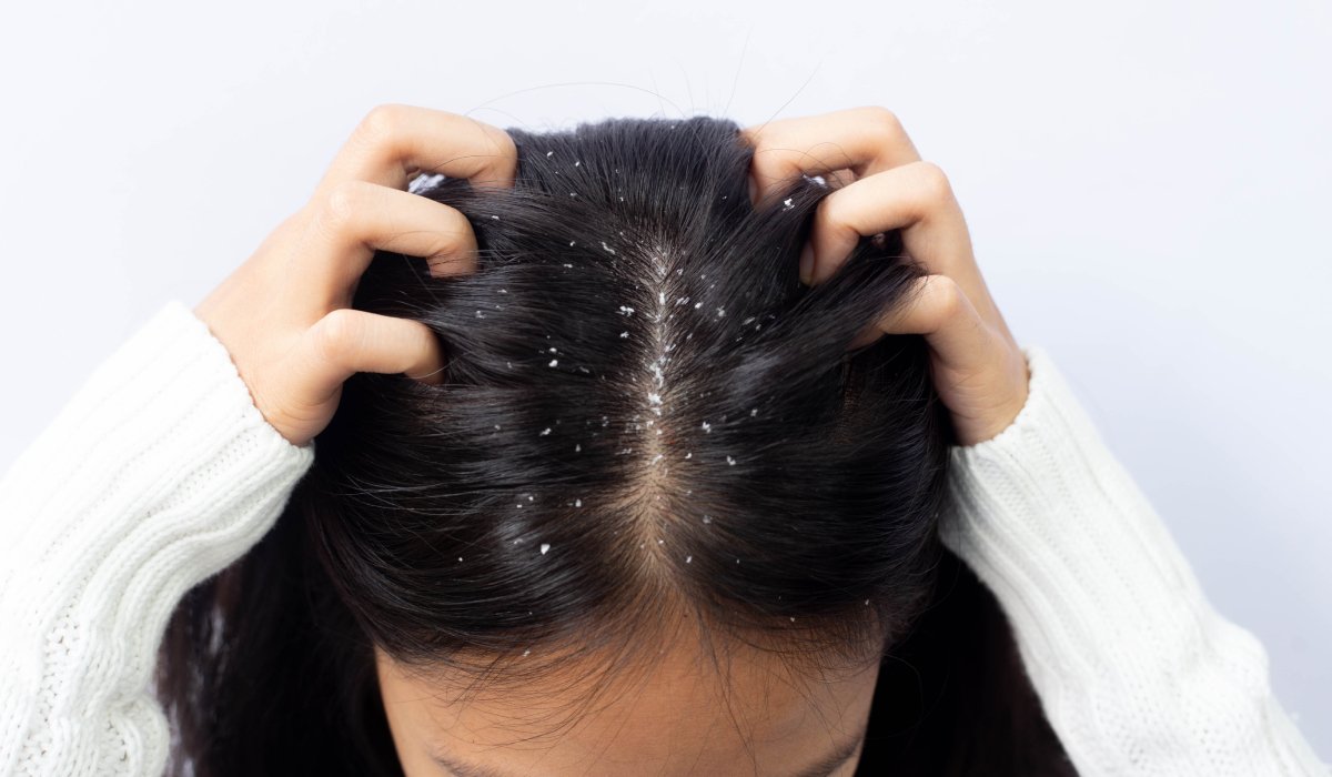 Cum poți scăpa de mătreață în mod natural. Obiceiurile care pot reduce exfolierea scalpului și preveni reapariția ei 1 wp header logo 1383