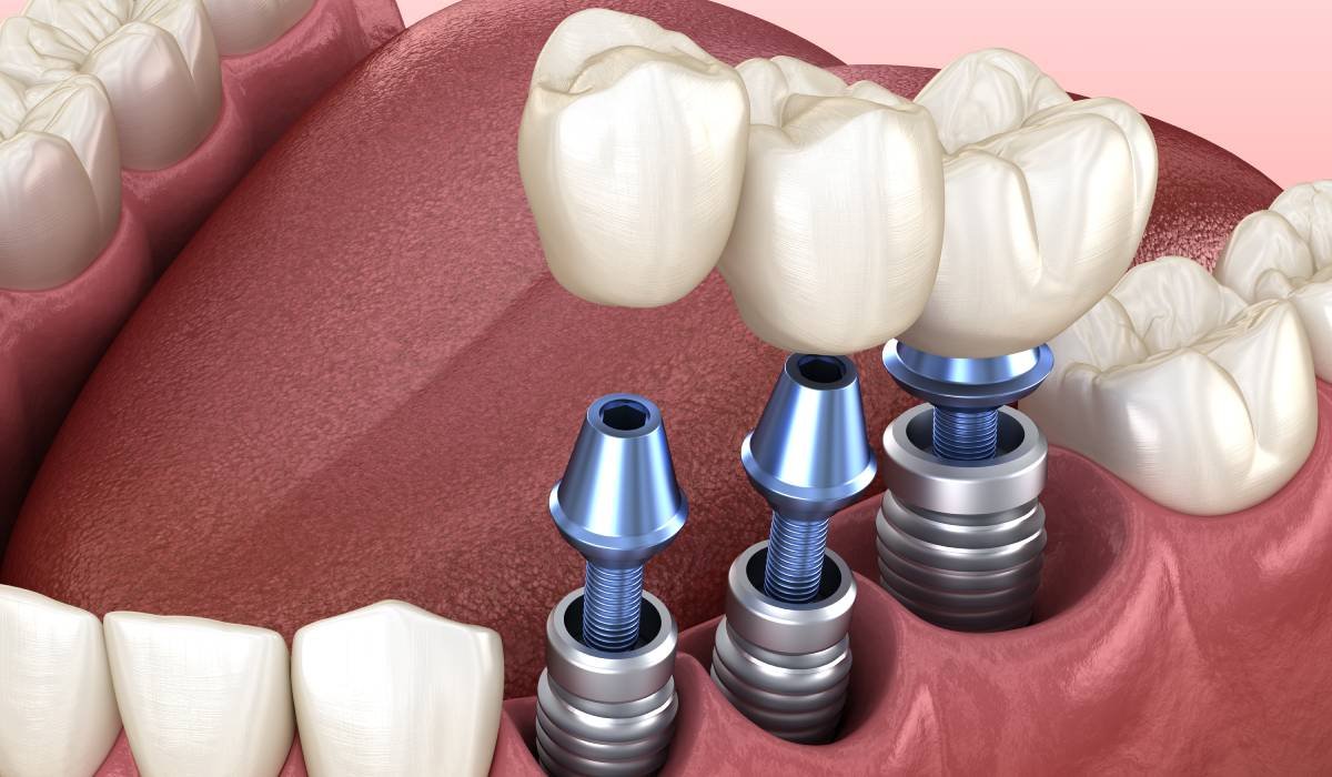 Dinți ficși în 24 de ore: mit sau realitate? Tot ce trebuie să știi dacă te-ai hotărât să-ți pui un implant dentar 1 wp header logo 1771