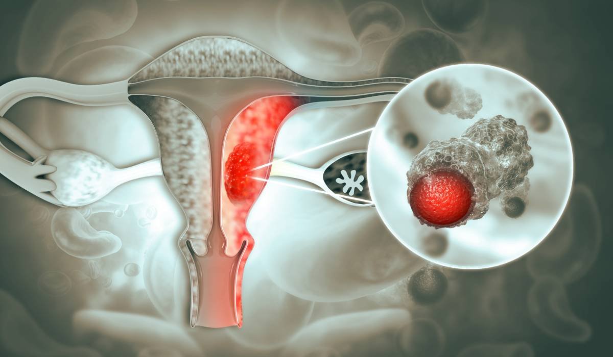 Peste 40% dintre femeile cu cancer ovarian află diagnosticul abia după o urgență medicală. Simptome pe care nu trebuie să le ignori, de la balonare persistentă, la urinări frecvente 1 wp header logo 657
