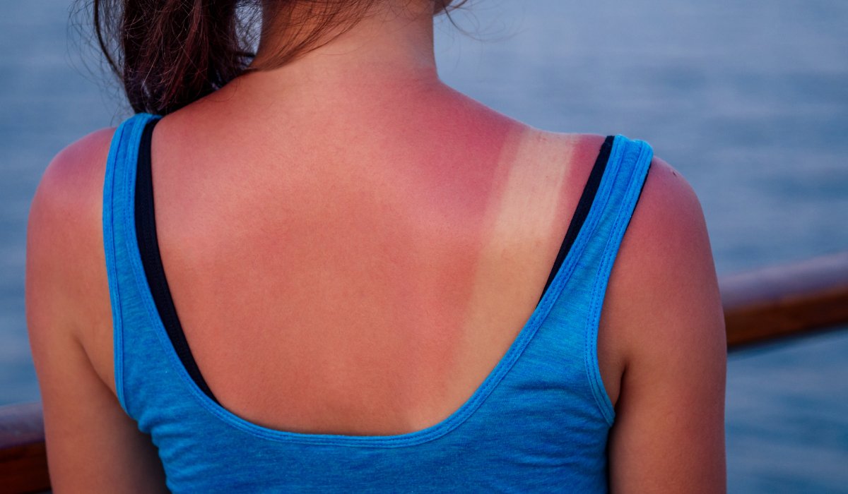 Arsurile solare nu sunt inofensive. Cinci episoade pot crește semnificativ riscul de cancer de piele 1 wp header logo 706