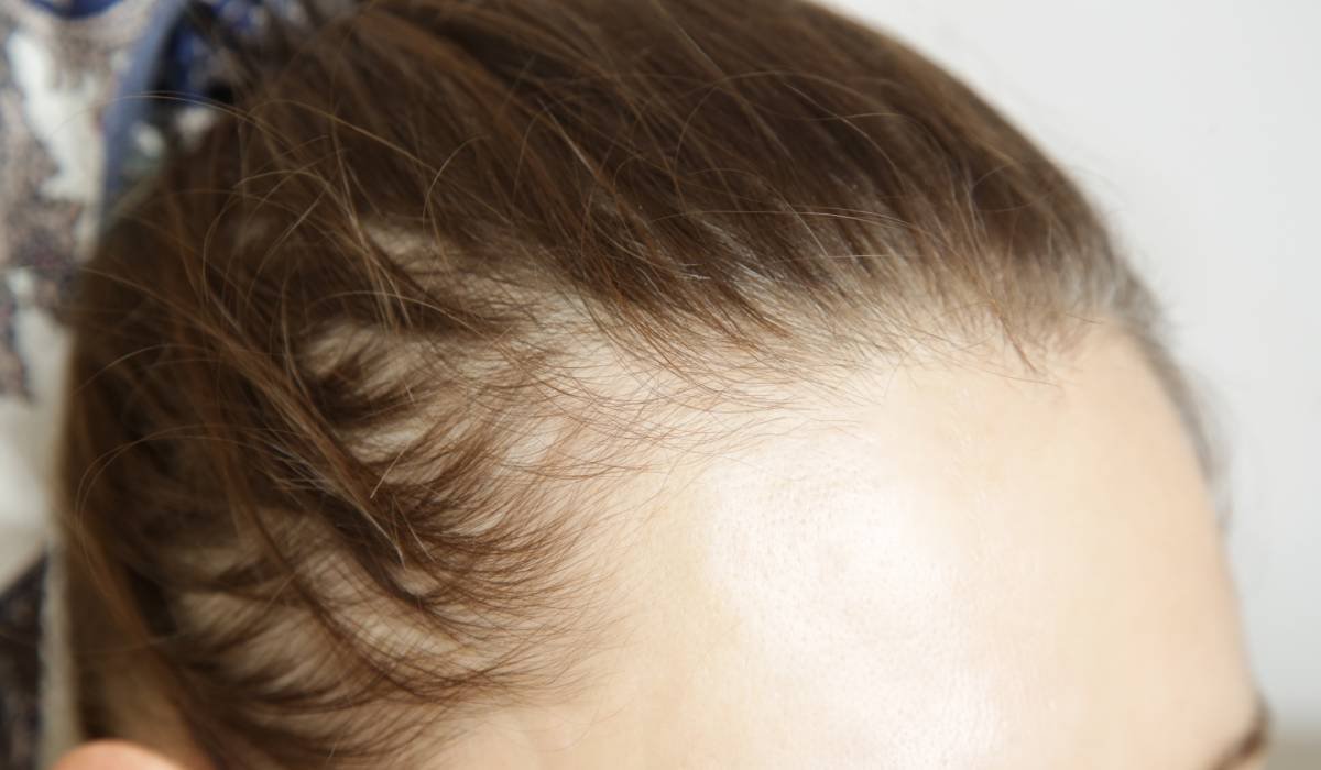 Slăbești, dar îți cade părul? Ce legătură au injecțiile pentru slăbit cu alopecia 1 wp header logo 1082